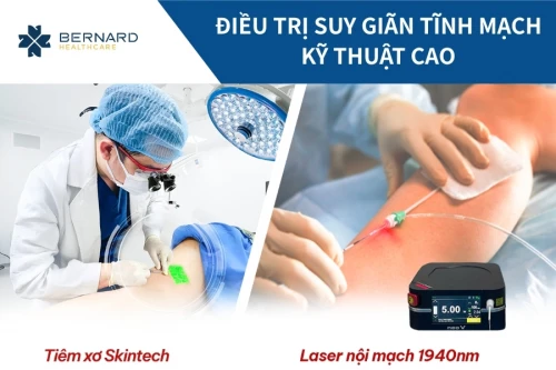 Điều trị suy giãn tĩnh mạch kỹ thuật cao